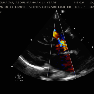 Tetralogy of Fallot
