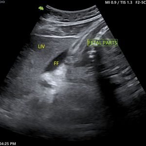 Uterine Rupture (in a 3rd trimester pregnancy)